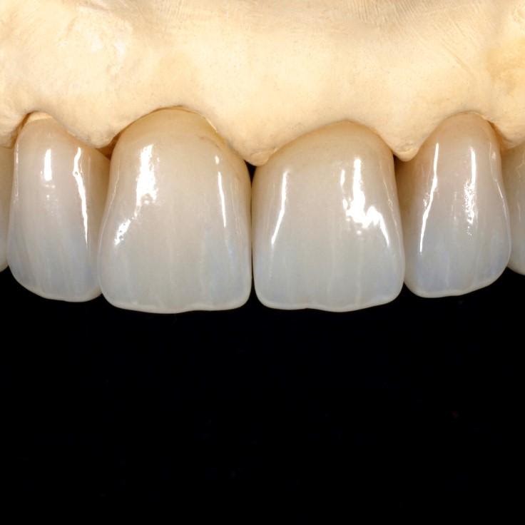 Anterior ceramic restorations by Unident Art Dental Lab