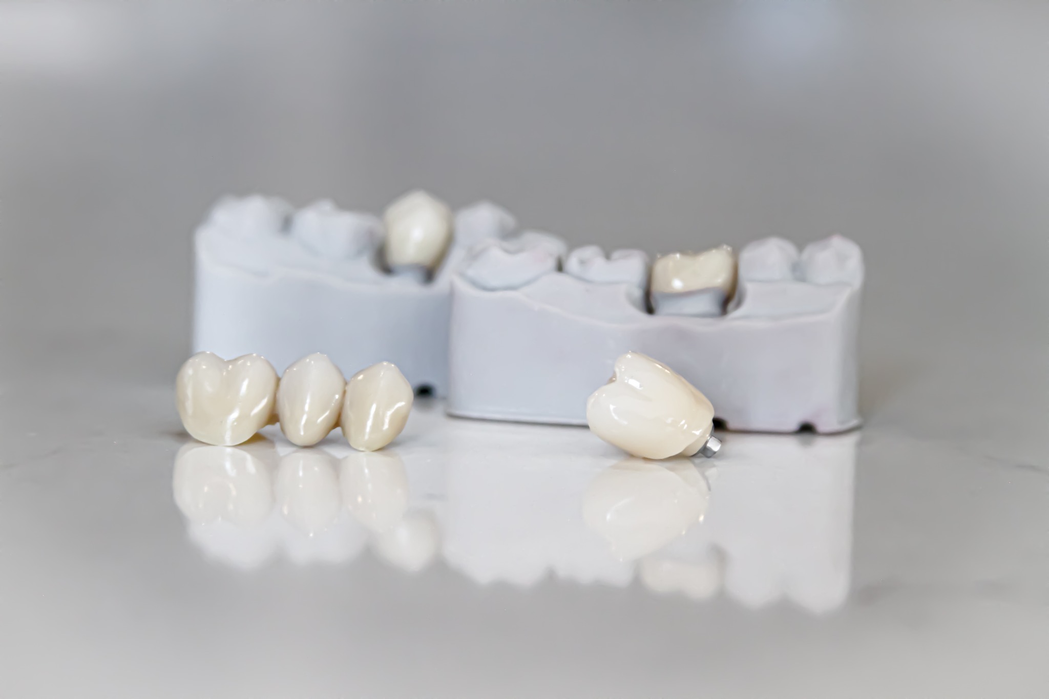 Implant crowns and models by Unident Art Dental Lab
